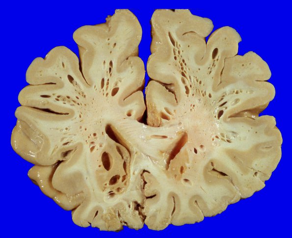 8A2 Artifact, terminal sepsis (Case 15) 2A