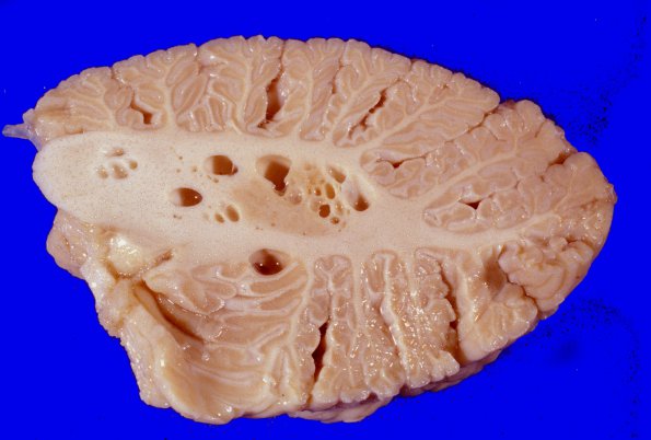 9 Artifact, terminal sepsis (WUMS Case) 2A