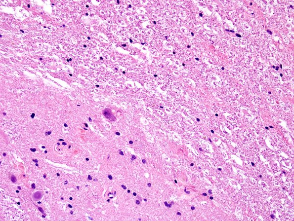 5A3 Artifact, toothpaste (Case 2) H&E 4