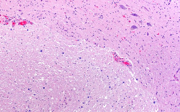 6B3 Artifact, toothpaste (Case 6) N15 H&E 20X 1