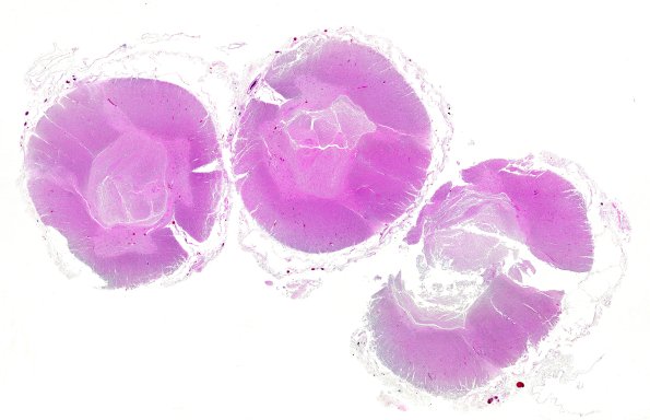 7A1 Toothpaste artifact (Case 7) N17 H&E WM