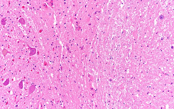 7A4 Toothpaste artifact (Case 7) N17 H&E 20X