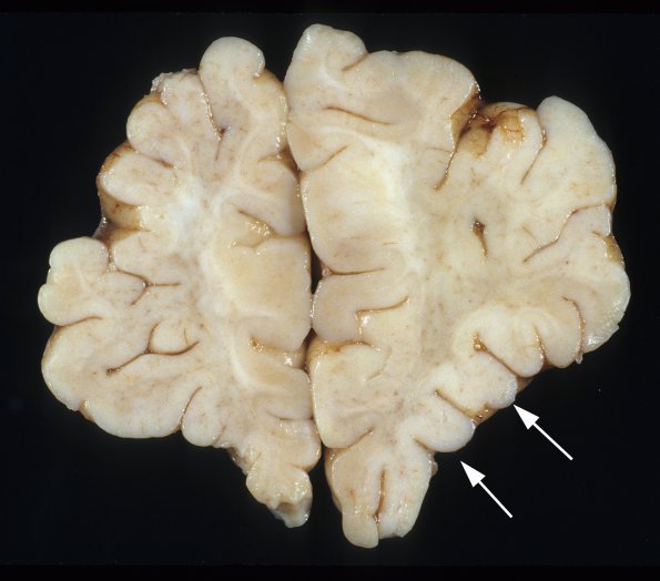 1A1 Artifact, cerebral cortex, resembles Tuber (Case 1) 1