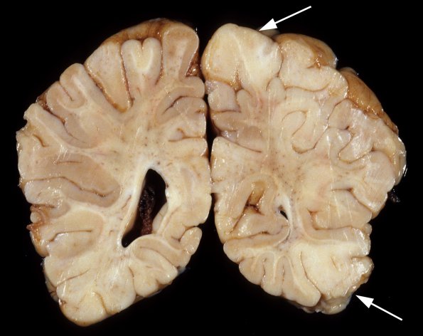 1A2 Artifact, cerebral cortex, resembles Tuber (Case 1) 2