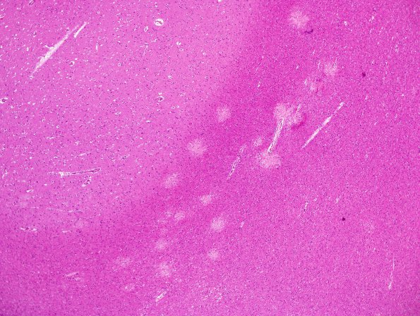 1A1 Artifact, subcortical WM (Case 1) H&E 1