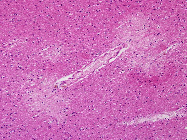 Artifact, subcortical WM (Case 1) H&E 2