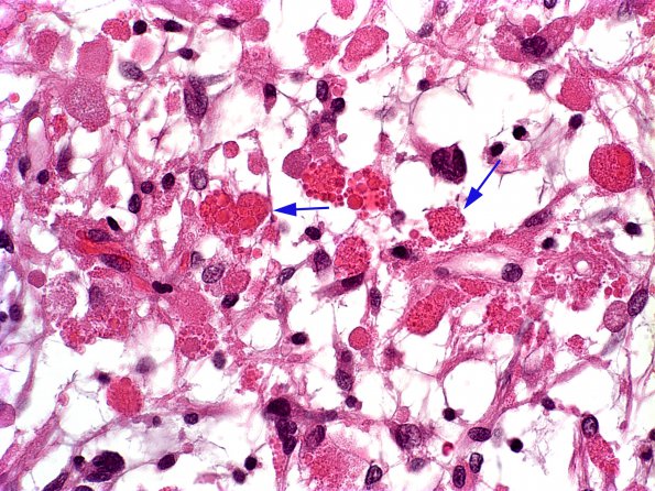 1A1 Astrocyte, (EGBs) pilocytic astrocytoma (Case 1) H&E 1