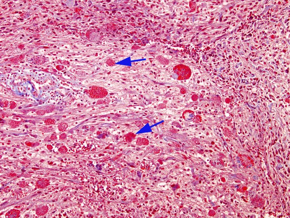 2A1 Astrocyte, eosinophilic granular bodies (EGBs) Trichrome (Case 7) 1