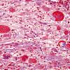 2A2 Astrocyte, eosinophilic granular bodies (EGBs) Trichrome (Case 7) 2