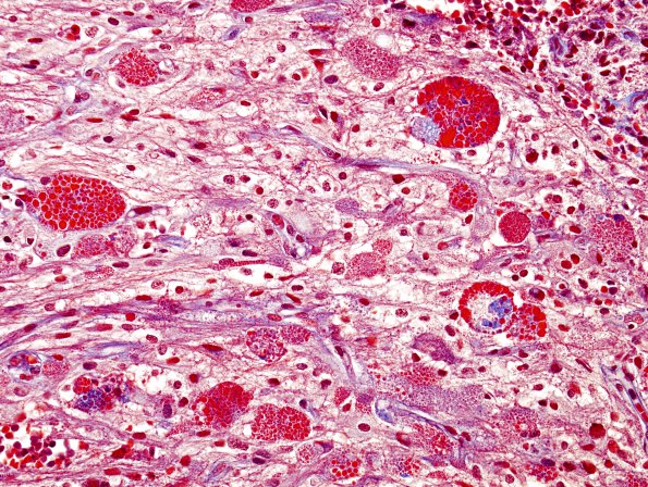 2A2 Astrocyte, eosinophilic granular bodies (EGBs) Trichrome (Case 7) 2