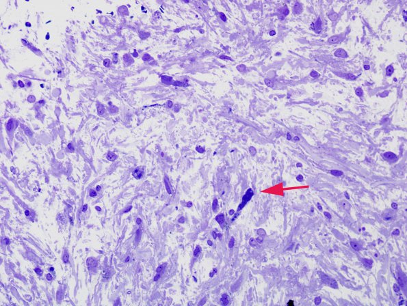 4A1 Astrocyte, Rosenthal fibers, EGBs, pilocytic astrocytoma (Case 2) One-micron thick plastic embedded section