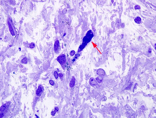 4A2 Astrocytoma, pilocytic (Case 2) 34 - Copy