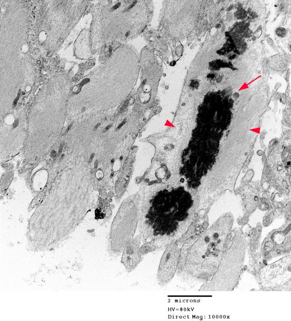 4A3 Astrocytoma, pilocytic (Case 2) 34 - Copy