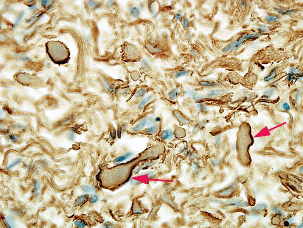 5 Astrocyte, Rosenthal fibers (Case 16) GFAP