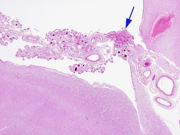 6A1 Astrocyte, Rosenthal fibers, H&E 1 (Case 17)  root of choroid plexus 1