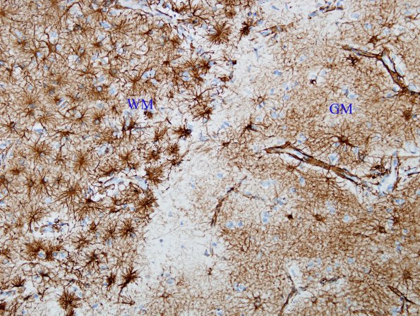 1A1 Astrocytes, GM-WM Junction (Case 20) GFAP 0