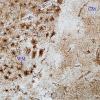 1A2 Astrocytes, GM-WM Junction (Case 20) GFAP 1