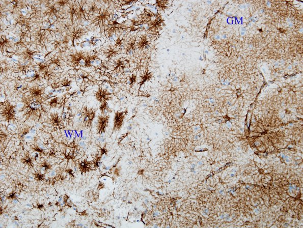 1A2 Astrocytes, GM-WM Junction (Case 20) GFAP 1