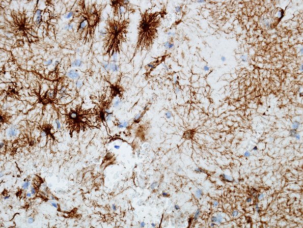 1A3 Astrocytes, GM-WM Junction (Case 20) GFAP 2