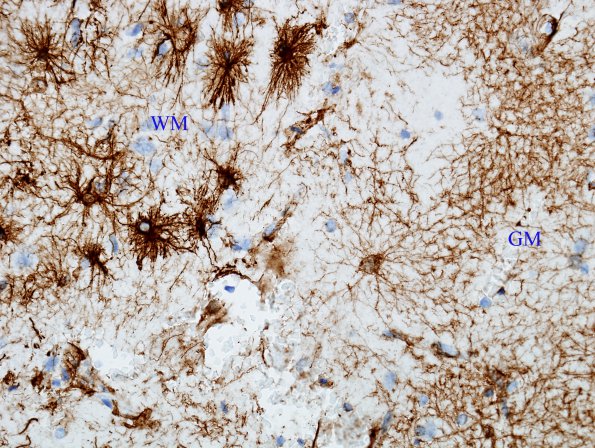 1A4 Astrocytes, GM-WM Junction (Case 20) GFAP 4