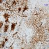 1A5 Astrocytes, GM-WM Junction (Case 20) GFAP 3