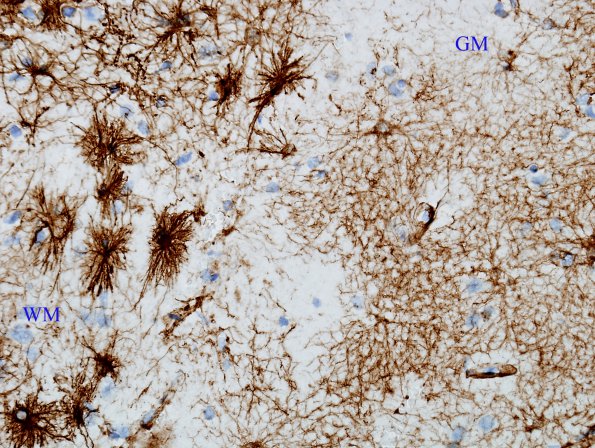 1A5 Astrocytes, GM-WM Junction (Case 20) GFAP 3