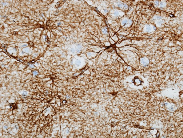 1A6 Astrocytes, GM (Control cortex, Case 20) GFAP 9