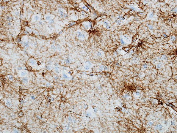 1A7 Astrocytes, GM (Control cortex, Case 20) GFAP 10