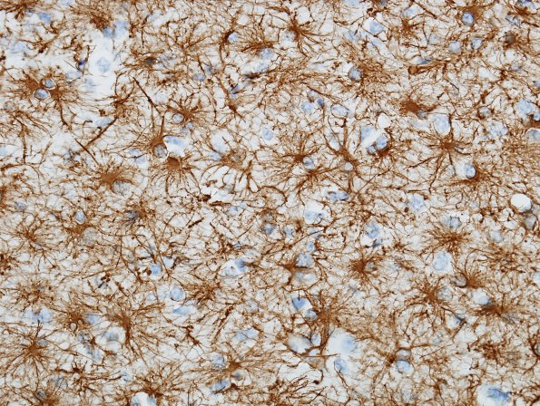 1A8 Astrocytes, WM (Case 20) GFAP 7