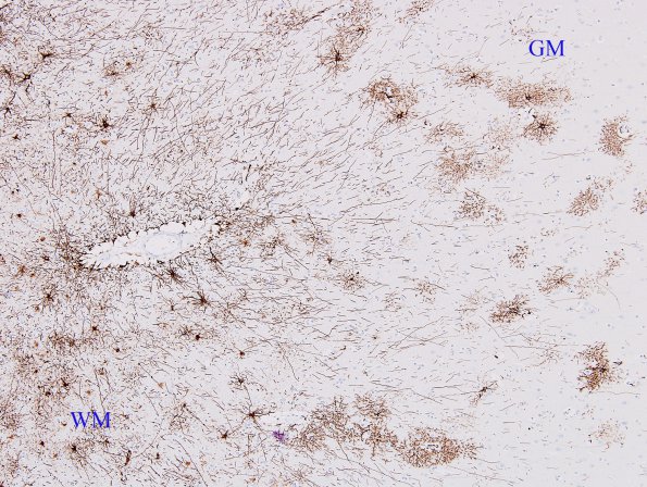 2A1 Astrocytes, GM-WM Junction (Control, Case 3) GFAP 2