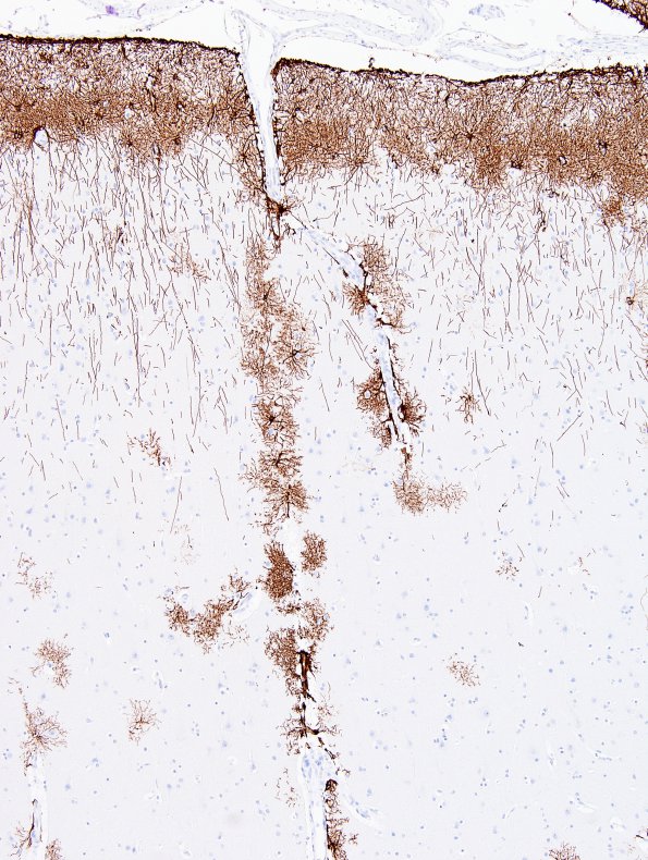 2A2 Astrocytes, GM (Control cortex, Case 3) GFAP 2