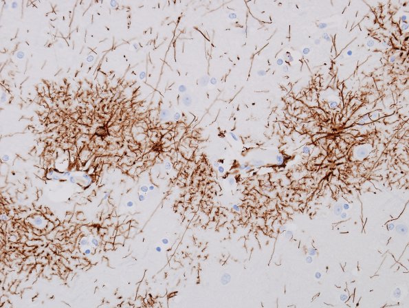 2A3 Astrocytes, GM (Control cortex, Case 3) GFAP 5