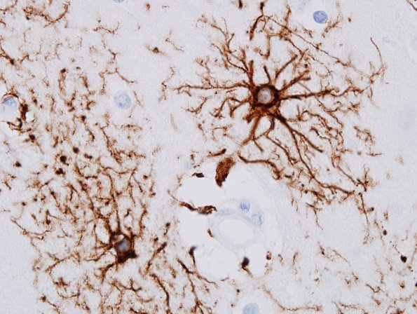 2A4 Astrocytes, GM (Control cortex, Case 3) GFAP 7