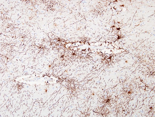 2A6 Astrocytes, WM (Control, Case 3) GFAP 3