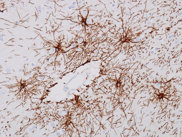 2A7 Astrocytes, WM (Control, Case 3) GFAP 18