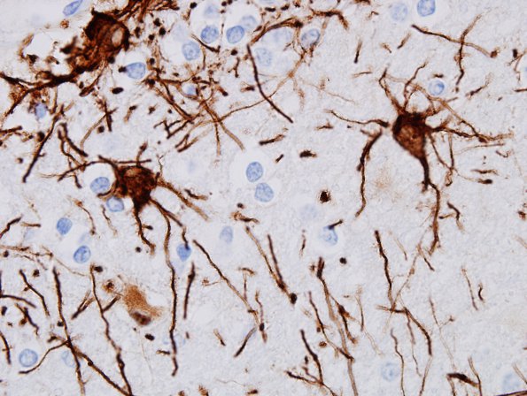 2A8 Astrocytes, WM (Control, Case 3) GFAP 24