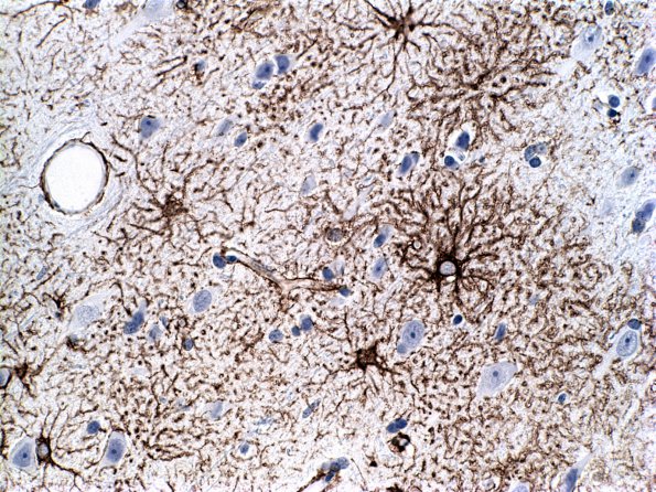 3A1 Astrocytes, GM (Case 9) 1