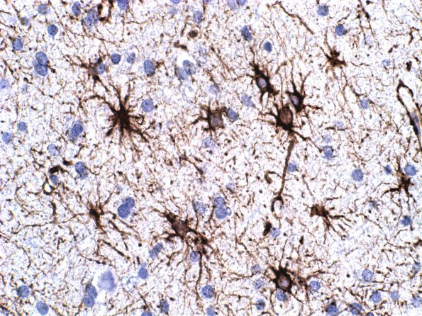 3A4  Astrocytes, WM (Case 9) GFAP 1