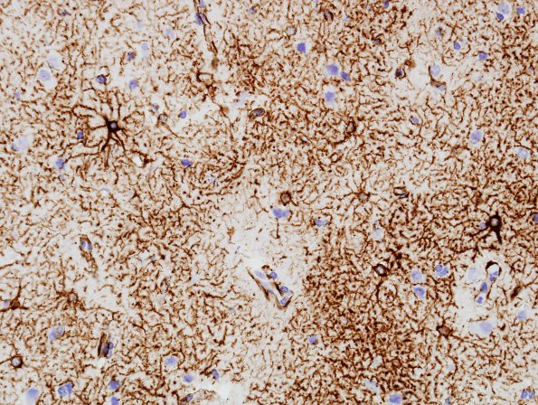 4A1 Astrocytes, 2 GM (Control cortex, Case 21) GFAP.