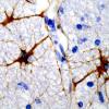 5 Astrocytes, WM (Case 10) GFAP 2