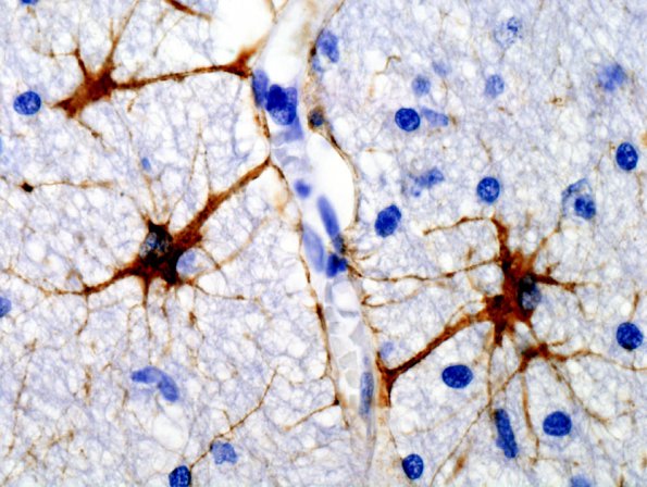 5 Astrocytes, WM (Case 10) GFAP 2