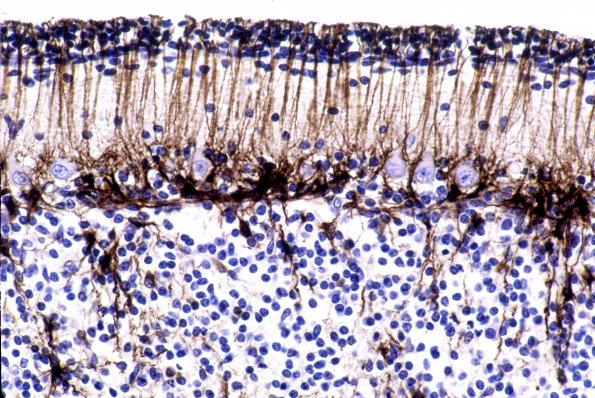 1A1 Astrocytes, radial glia (Case 1) GFAP 1