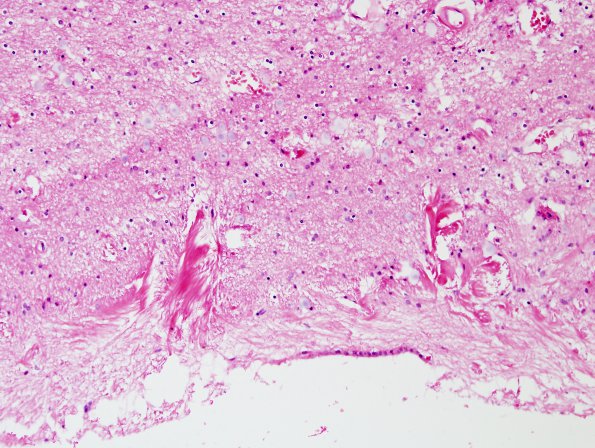 10 Astrocytosis, Wheat Sheaving (Case 22) H&E 2