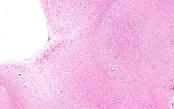 11A1 Cerebral Palsy (Case 23) 2X H&E