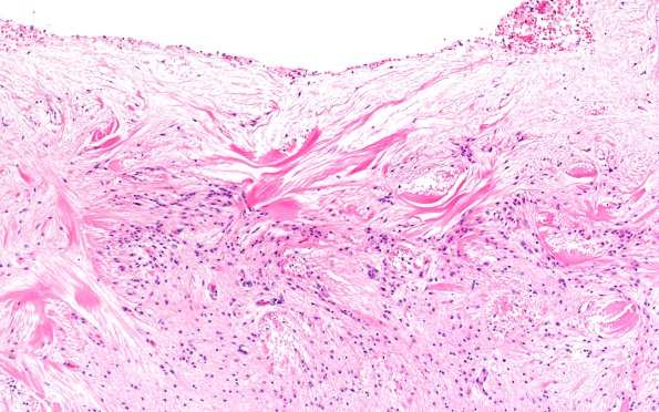 11A3 Cerebral Palsy (Case 23) 10X H&E 2 better