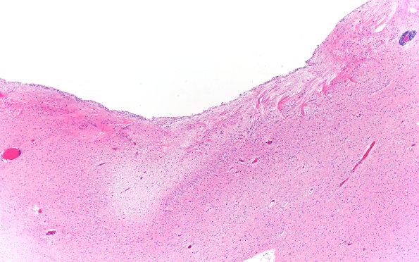 11A4 Cerebral Palsy (Case 23) H&E 4X 2