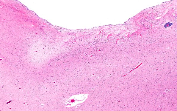11A5 Cerebral Palsy (Case 23) H&E 4X