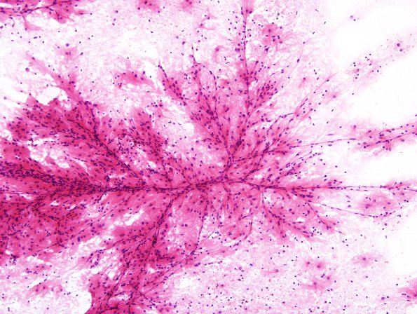 1A1 Astrocytosis (Case 4) smear H&E 1