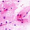 1A2 Astrocytic proliferation (Case 4) smear H&E 2