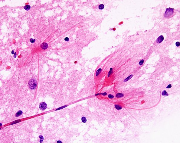 1A2 Astrocytic proliferation (Case 4) smear H&E 2